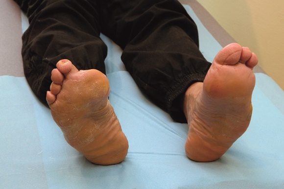 Every year thousands of people lose their toes and limbs due to diabetic-related complications