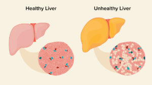 What Is Fatty Liver And How Can I Prevent It? - Go Grub It