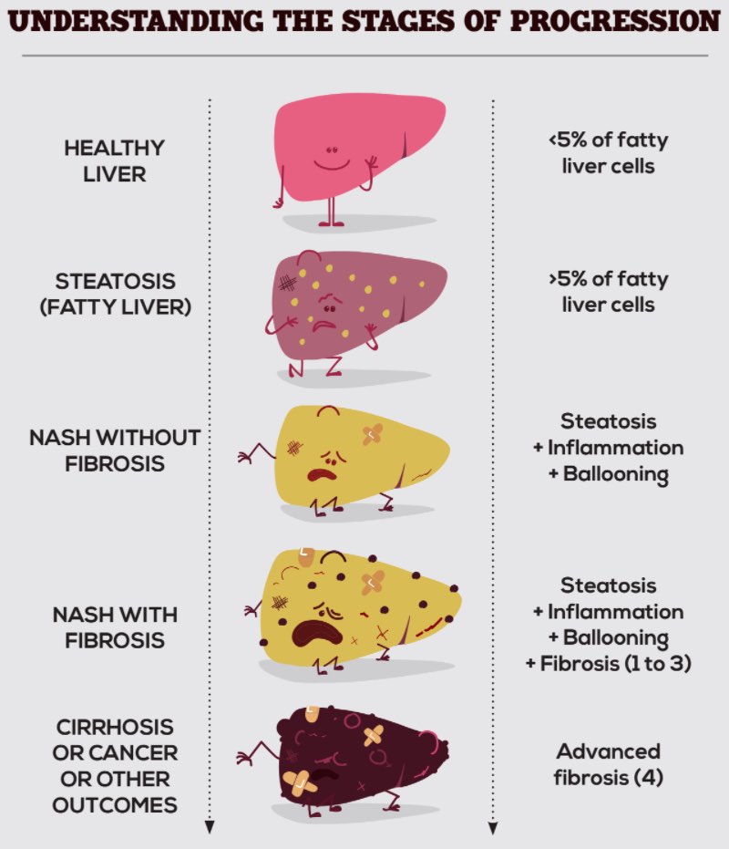 Healthy vs fatty liver