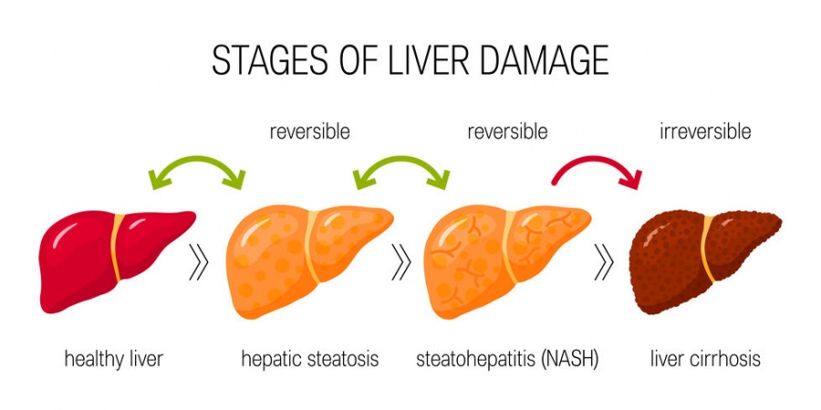 The stages of liver damage