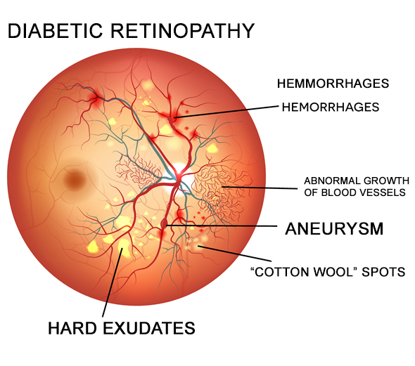 Diabetic retinopathy is a common microvascular complication in diabetes