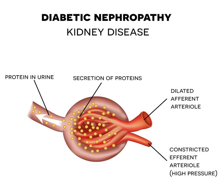 Urine micro-albumin is an early sign of diabetic nephropathy