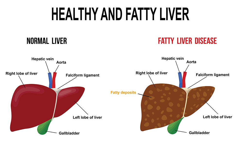 Fatty liver is accumulation of fat in your liver