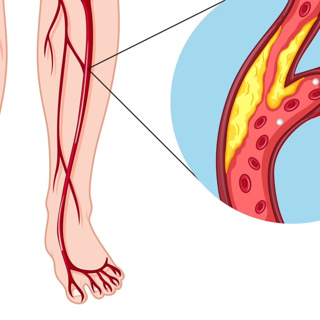 Peripheral vascular disease