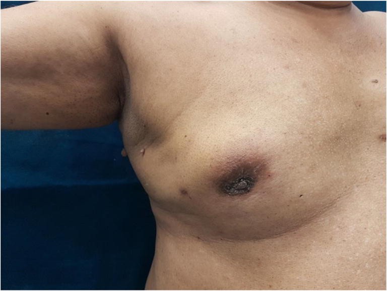 Nipple and skin retraction over the breast are some of the skin changes associated with breast cancer 