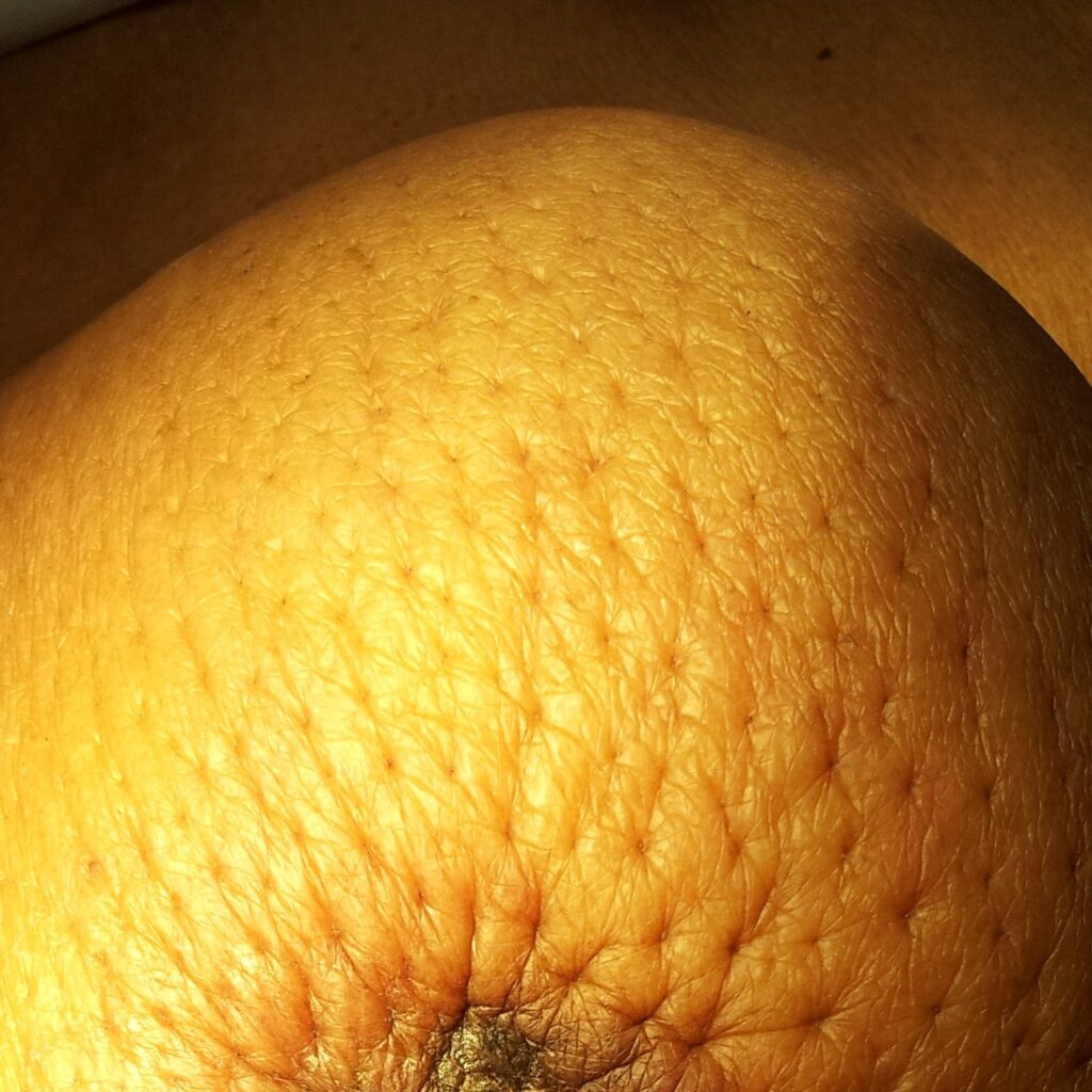 Peau d'range (orange peal) appearance of skin, it's a skin change associated with breast cancer